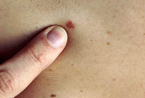 paraben menyebabkan kanker kulit