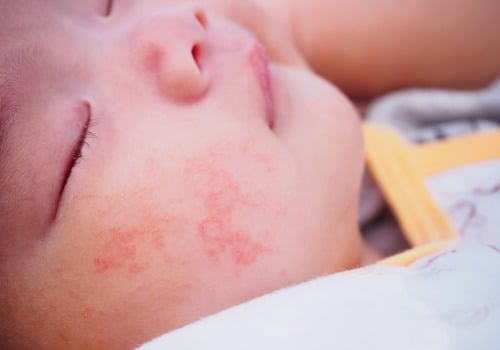 Cara Mengenali dan Menghilangkan Bintik Merah di Wajah Bayi