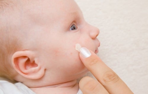 cara menghilangkan bintik merah di wajah bayi