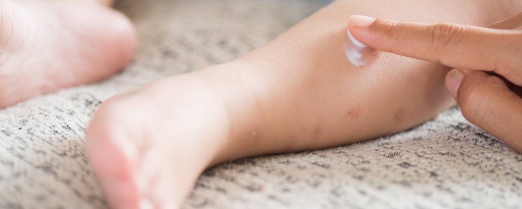 Cara Menghilangkan Bekas Gigitan Nyamuk Pada Bayi
