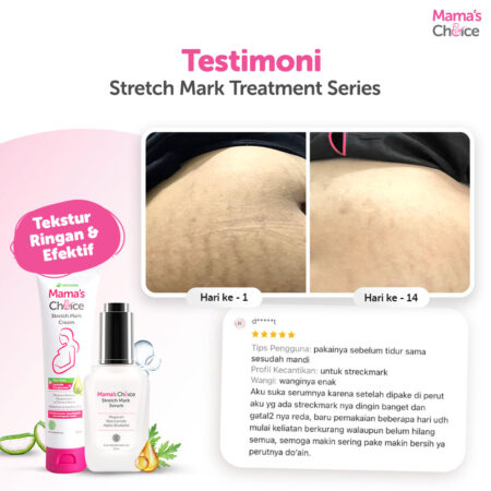Testimoni | Stretch Mark Treatment Series Mama's Choice (Stretch Mark Cream + Stretch Mark Serum) Obat Krim Strechmark Terdaftar BPOM