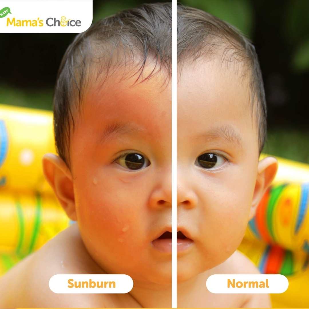 Before After Penggunaan Sunscreen Pada Bayi